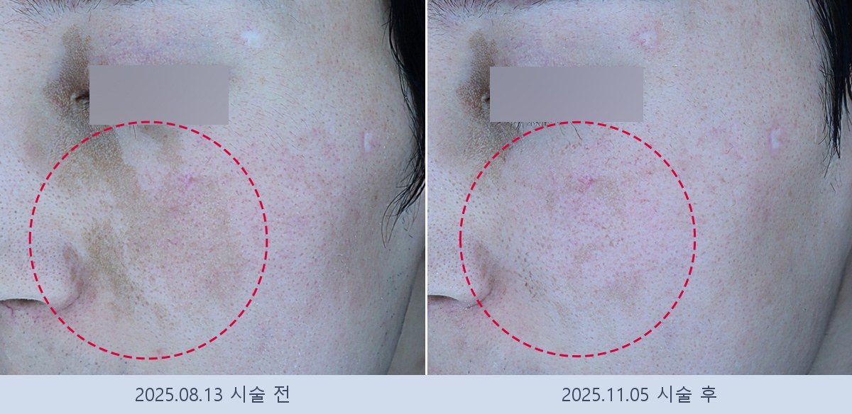 흑자 검버섯