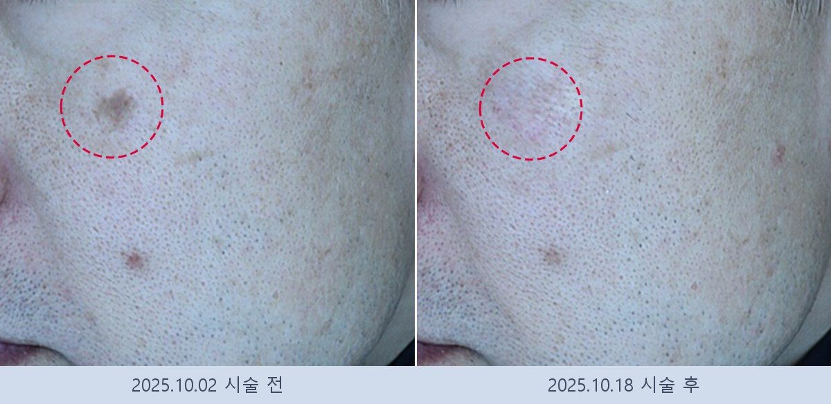 흑자 검버섯